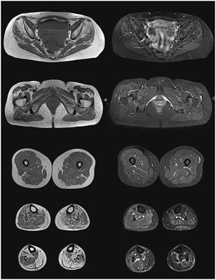 First Family of MATR3-Related Distal Myopathy From Italy: The Role of Muscle Biopsy in the Diagnosis and Characterization of a Still Poorly Understood Disease